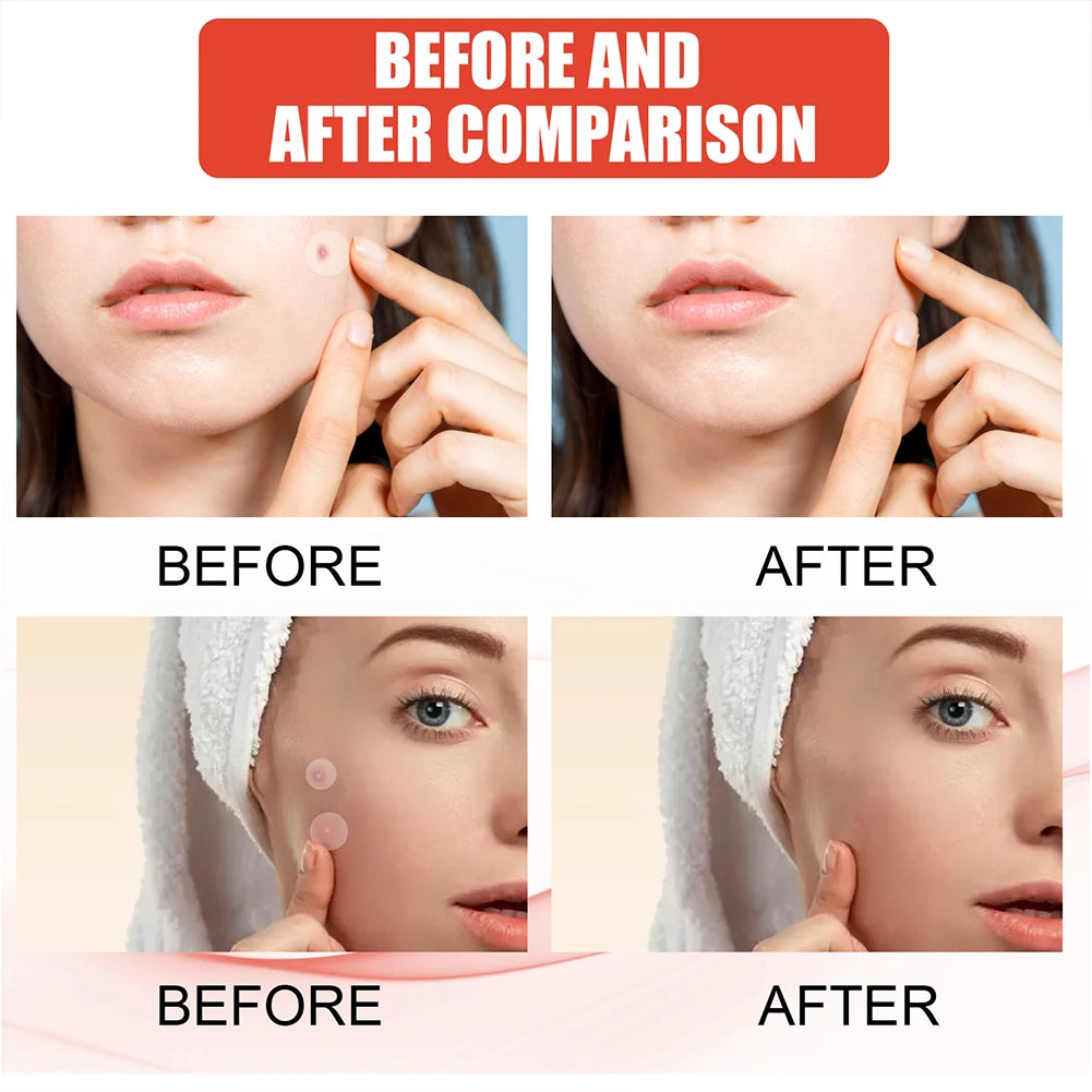Acne Star/Heart Pimple Patches 240pcs