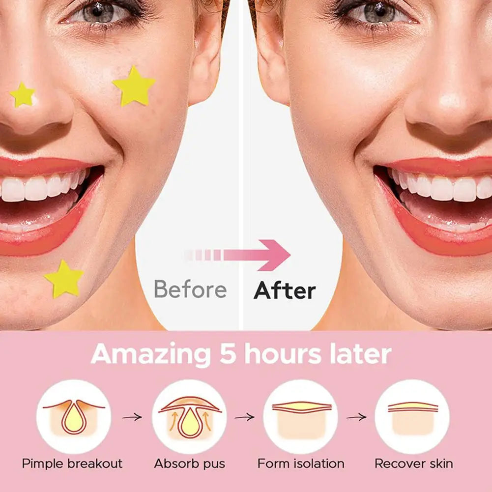 Star Acne Patches