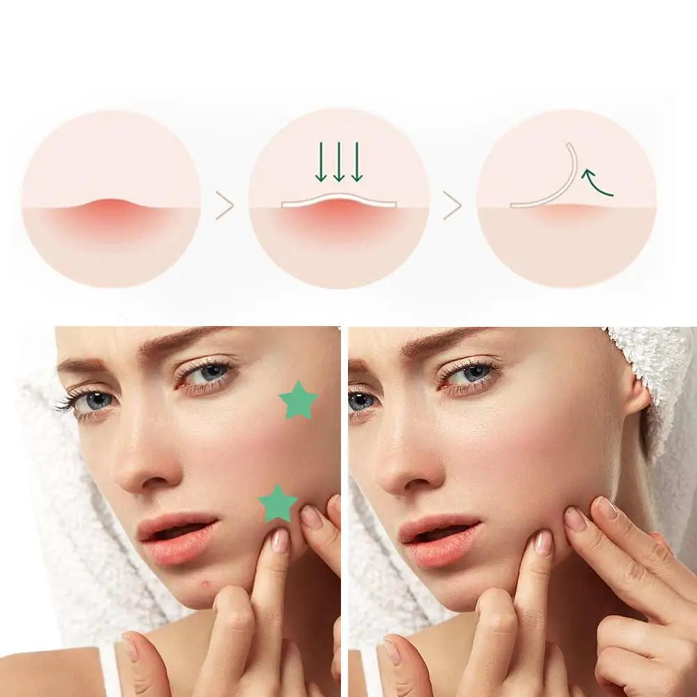 Star Acne Patches