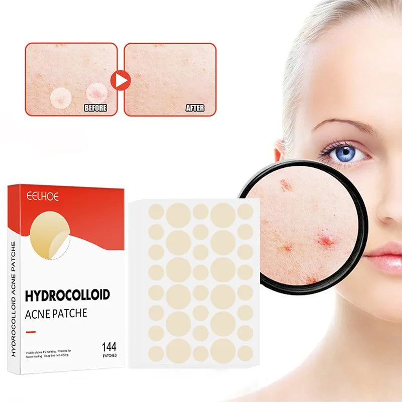 Acne Pimple Patches